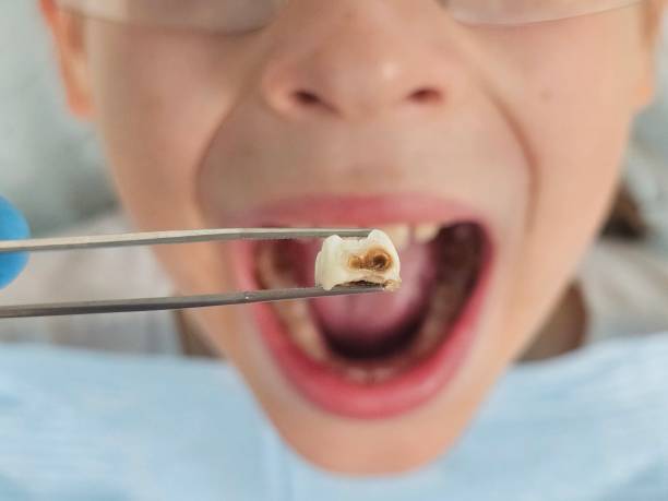 Best Emergency Root Canal Treatment in Athens, AL